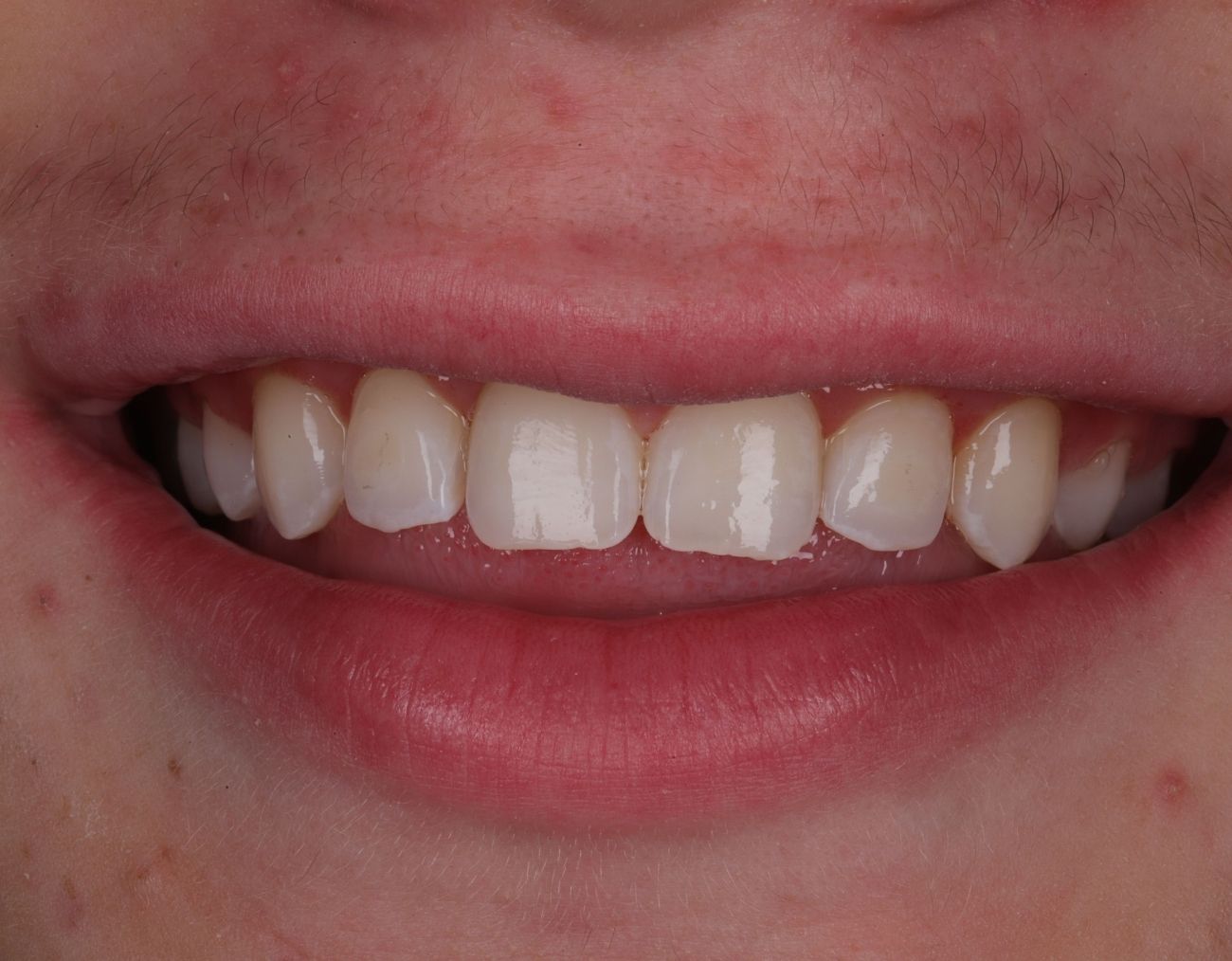 after-braces-1.jpg