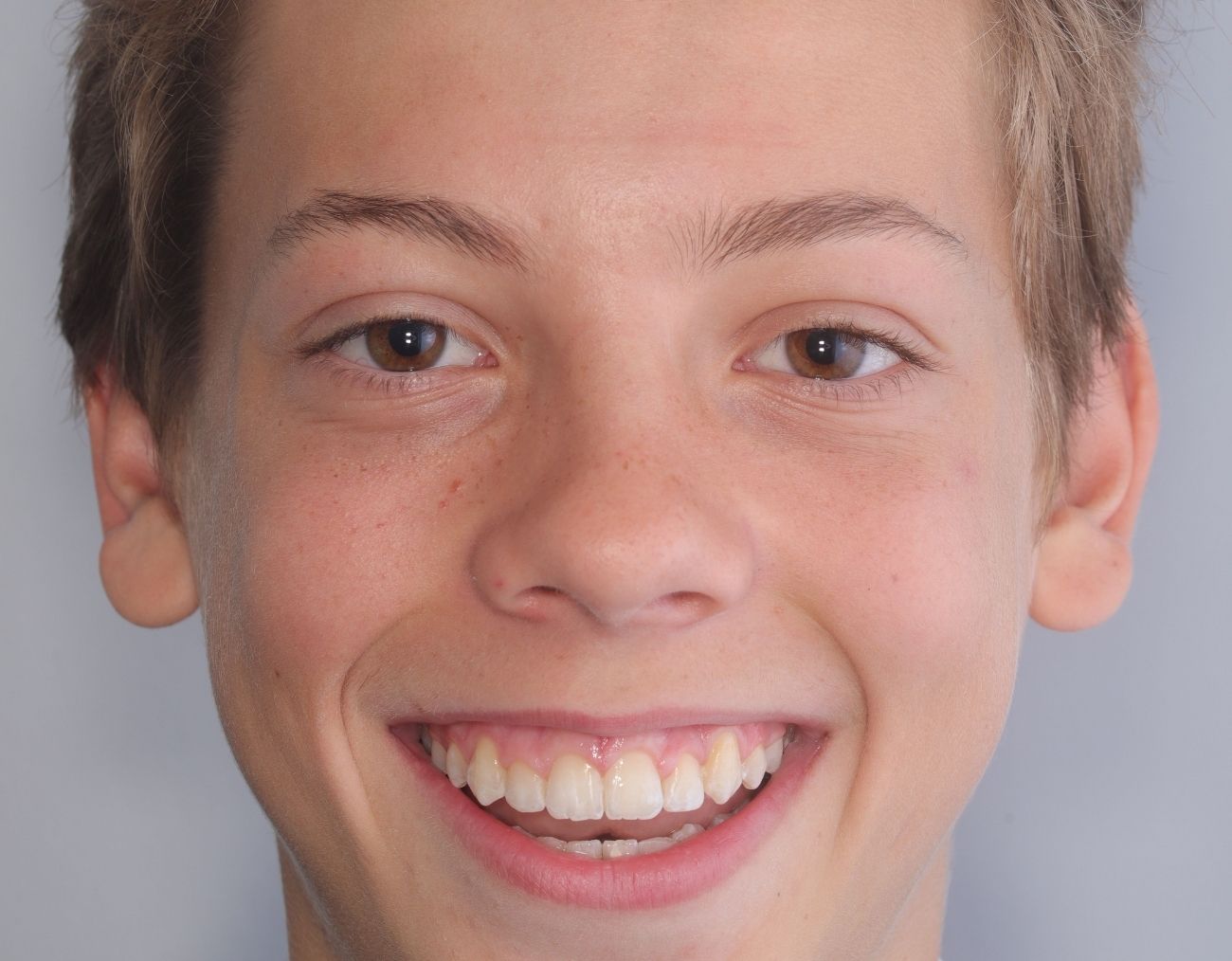 after-braces-3.jpg