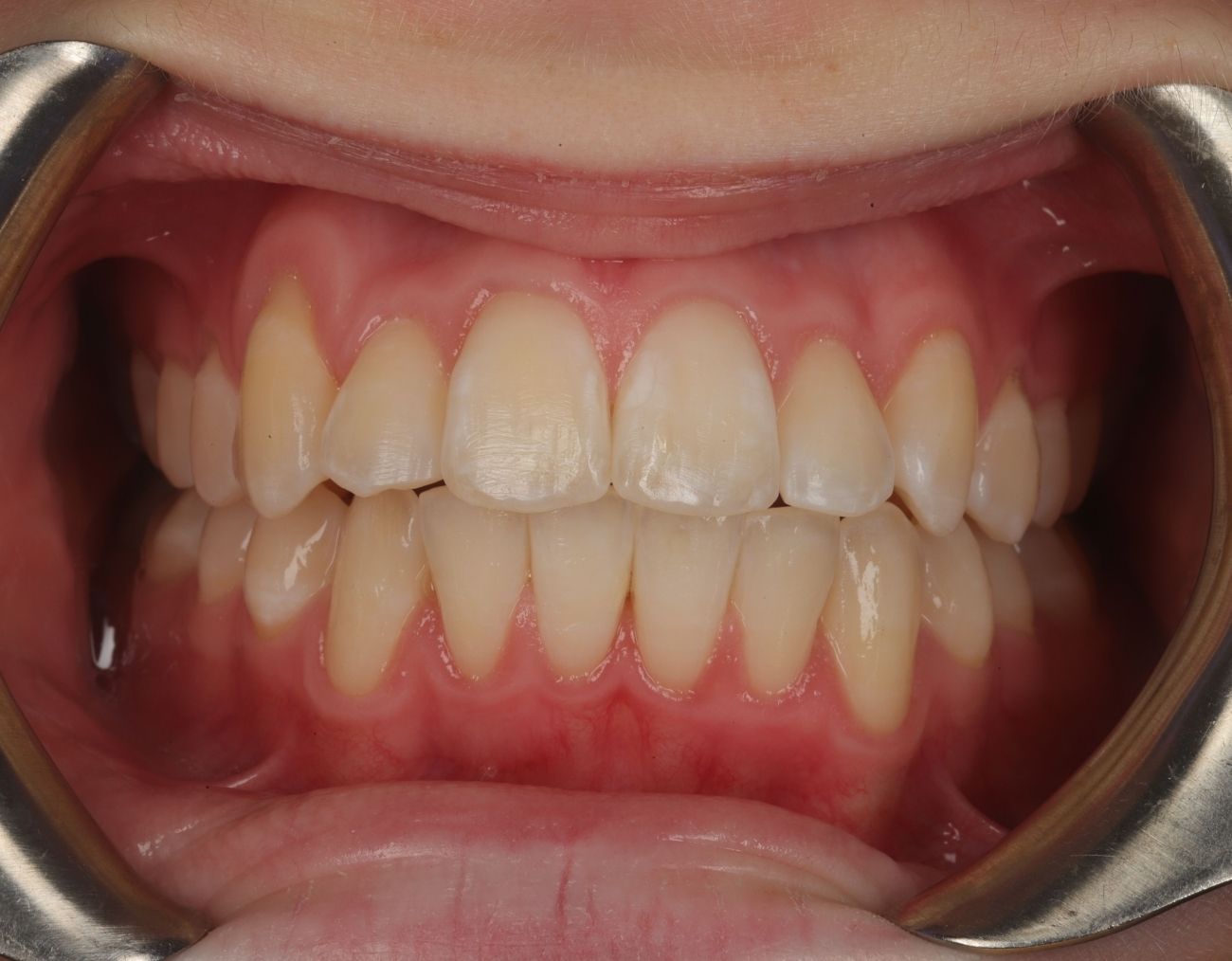 after-braces.jpg