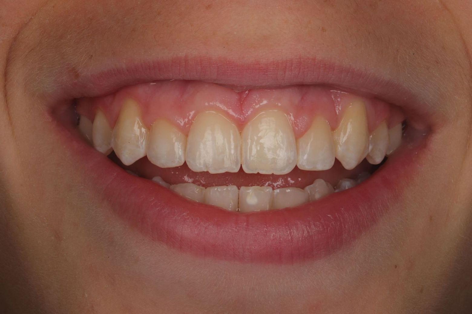 after-fixed-braces.jpg