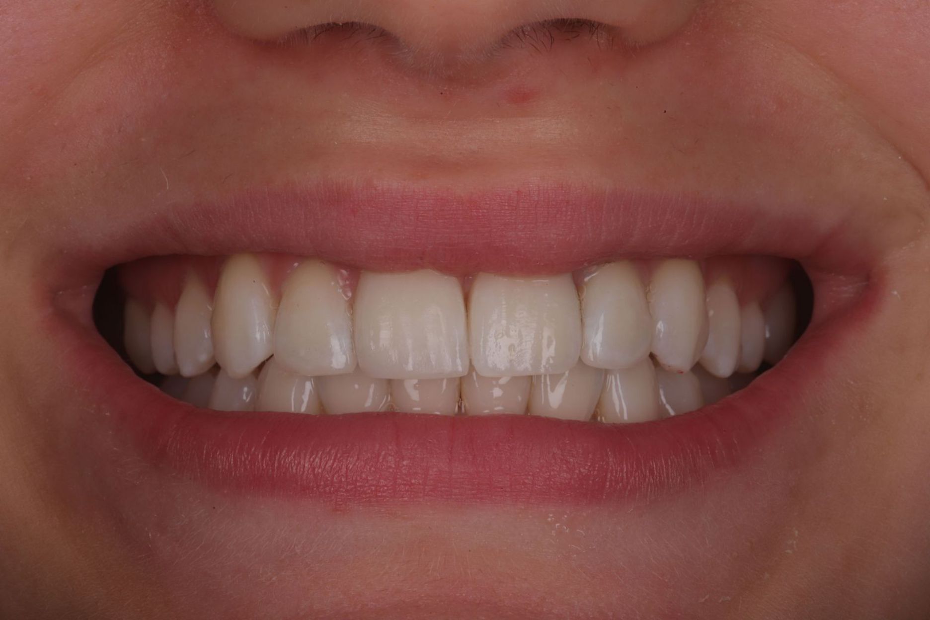 after-invisalign-photo.jpg