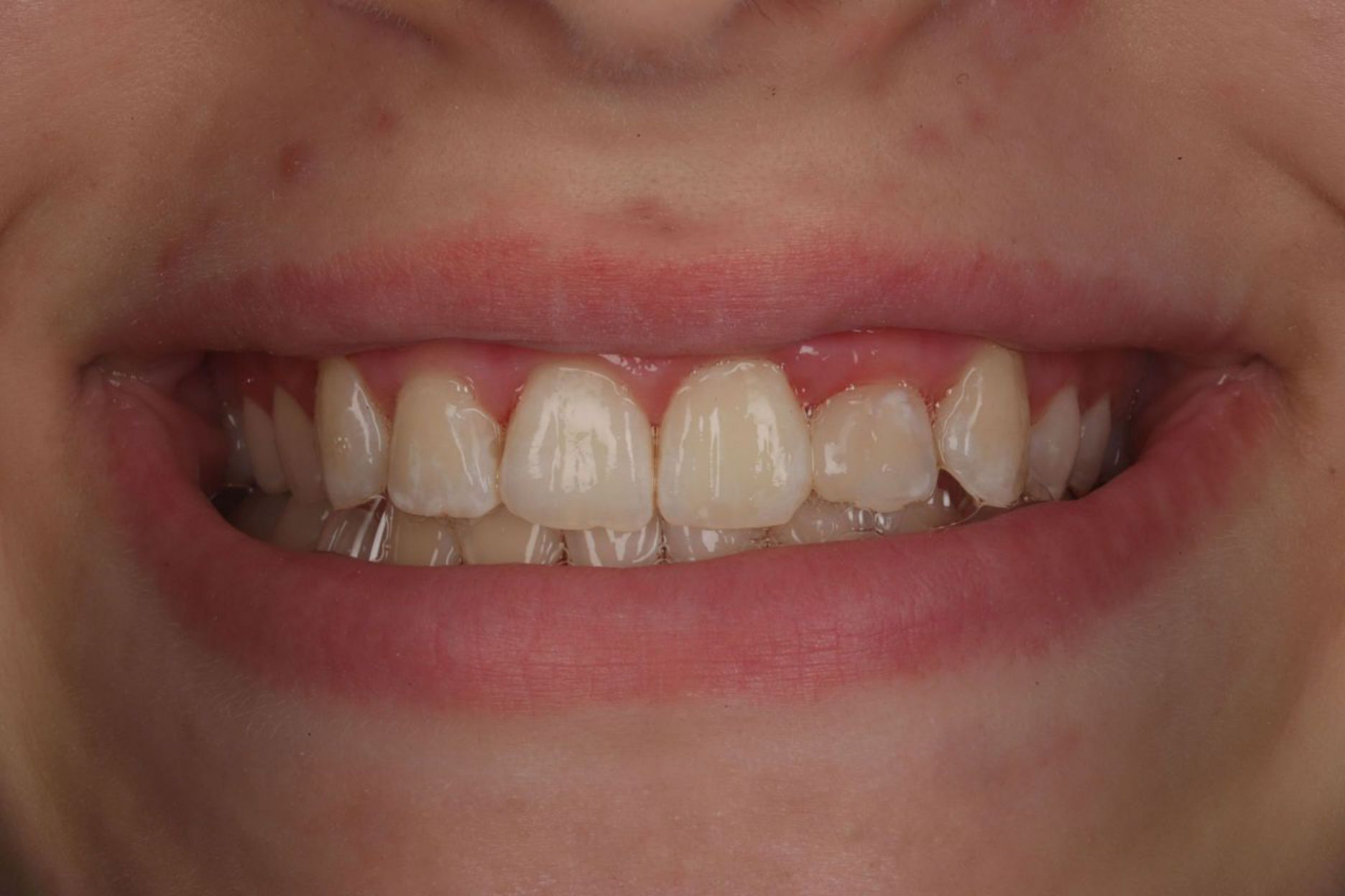 after-spark-aligners.jpg