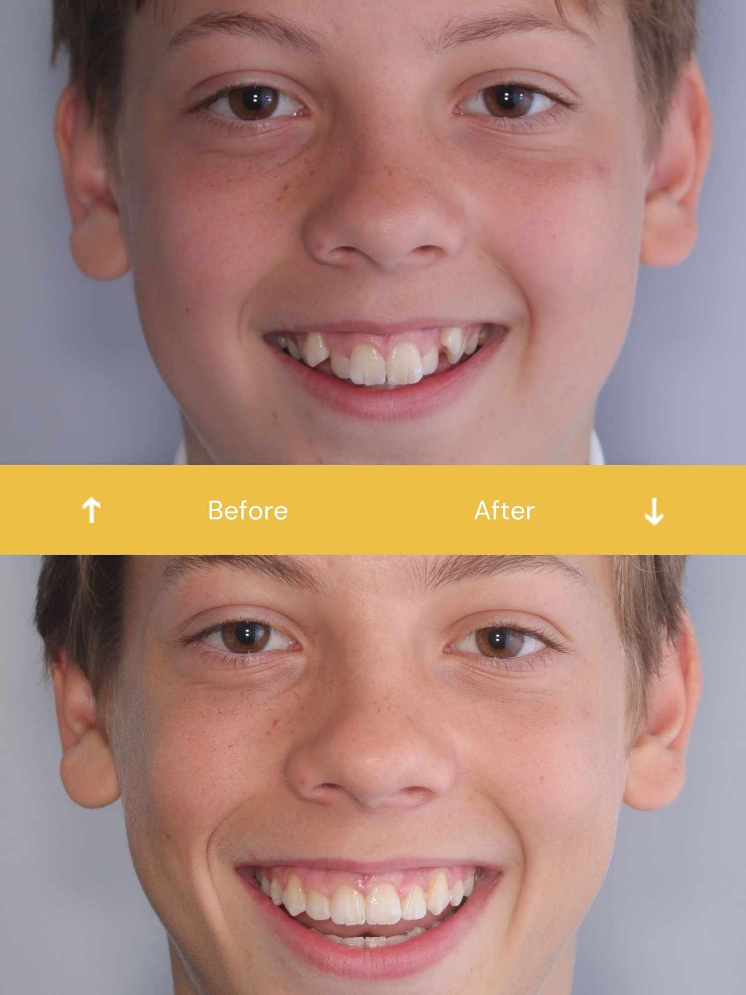 before and after braces
