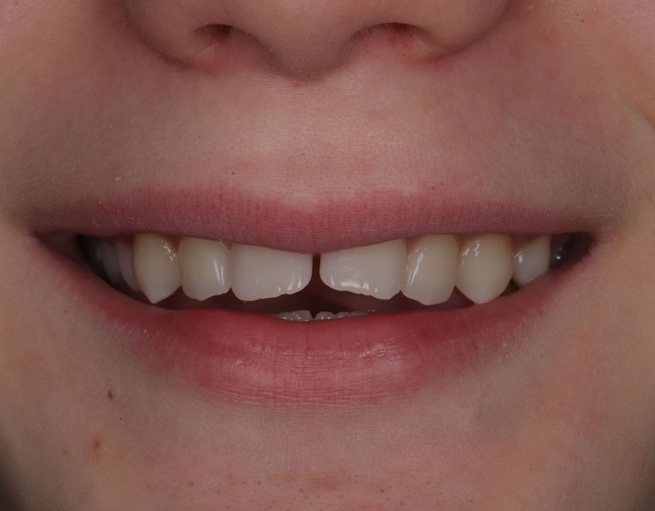 before-braces-1.jpg