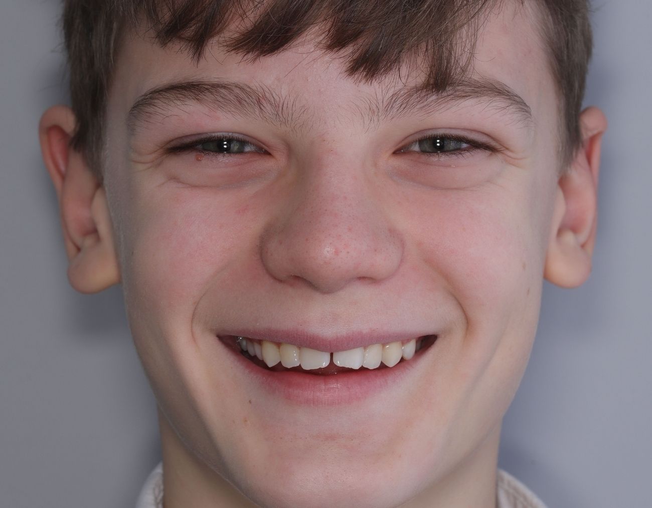 before-braces-2.jpg