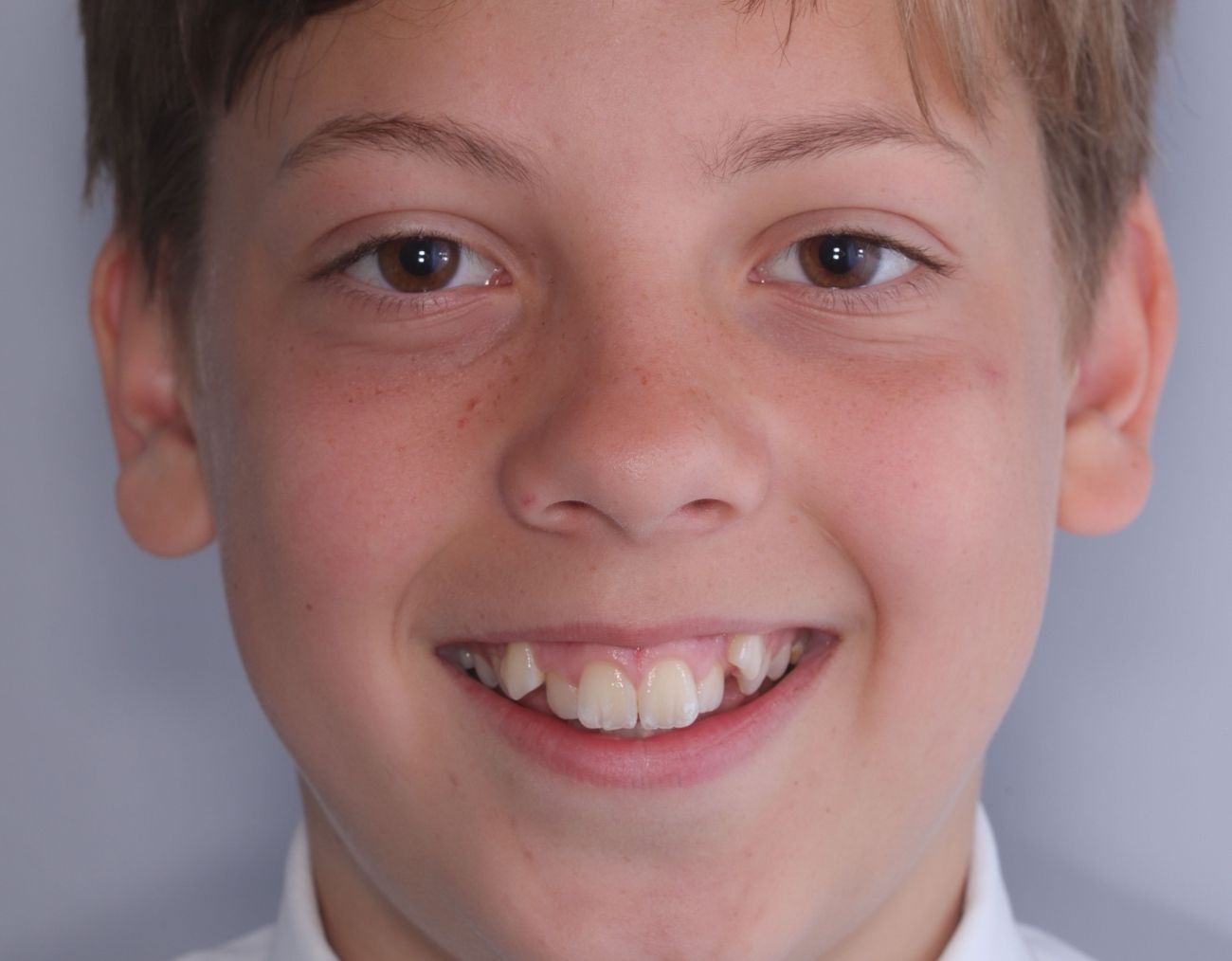before-braces-3.jpg