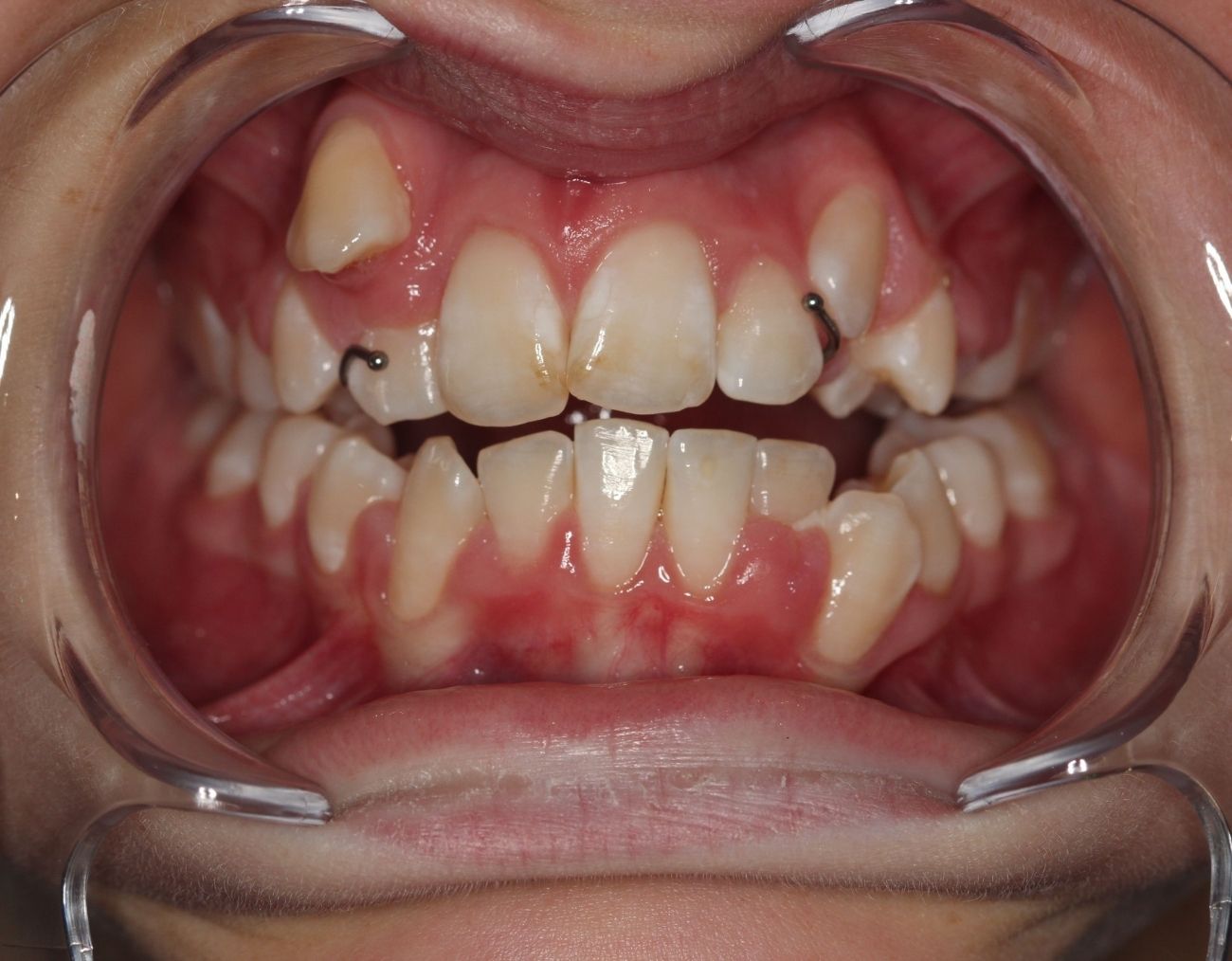 before-braces.jpg