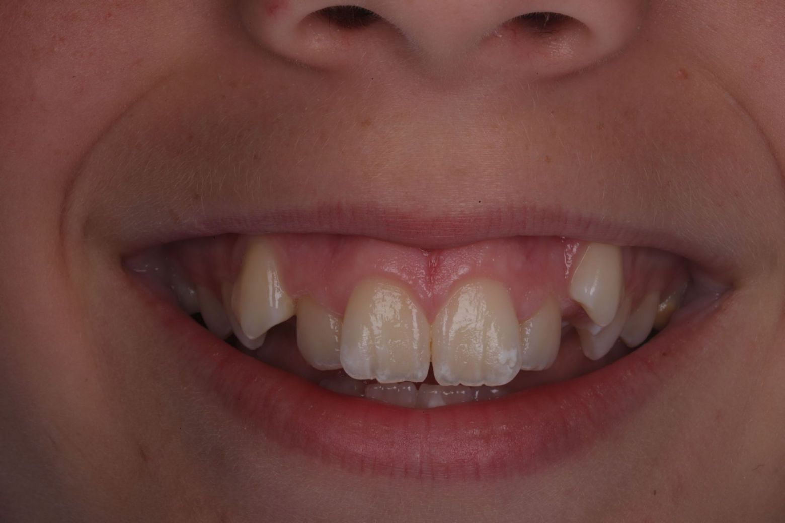before-fixed-braces.jpg