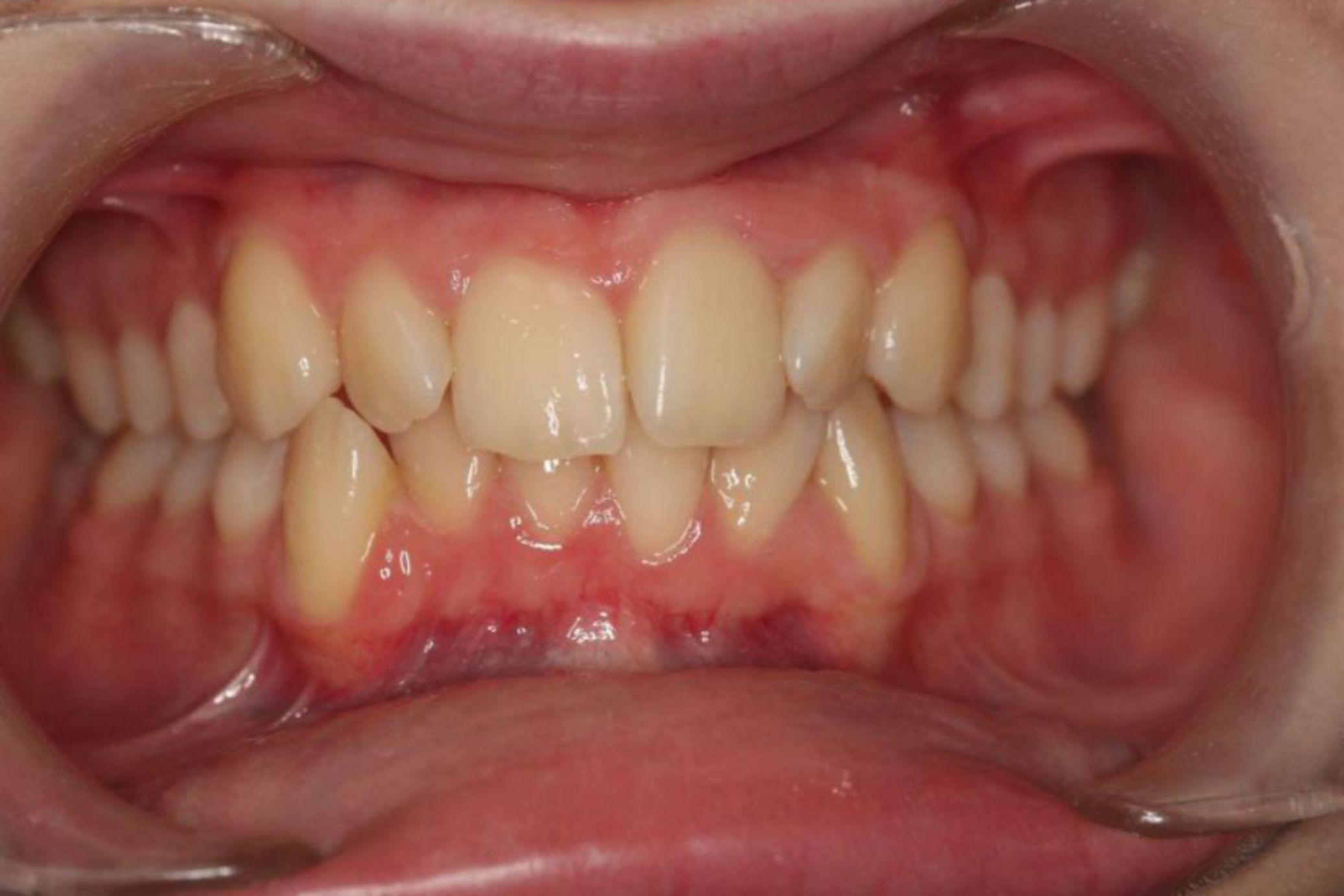 before-invisalign-photo.jpg