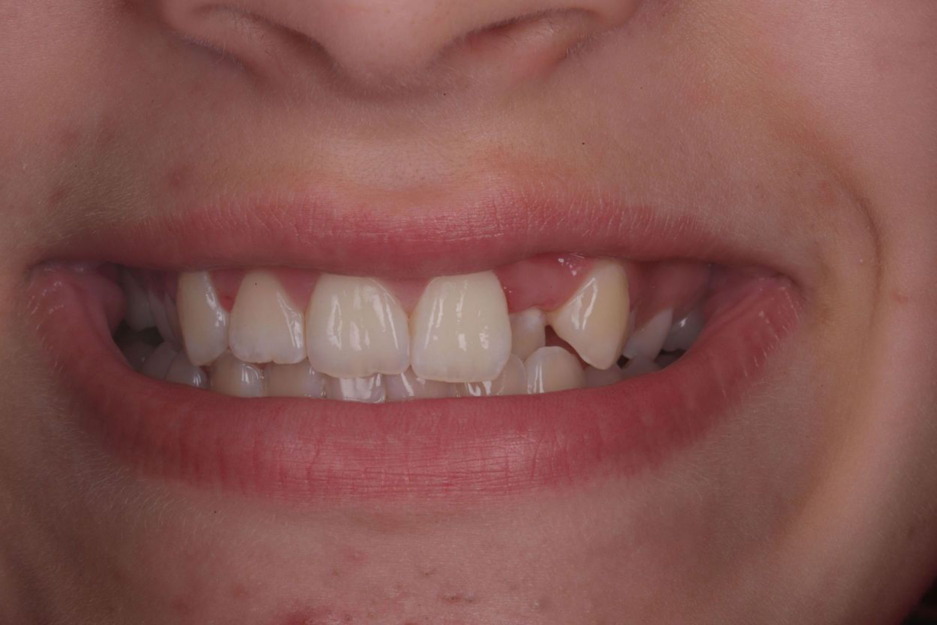 before-spark-aligners.jpg