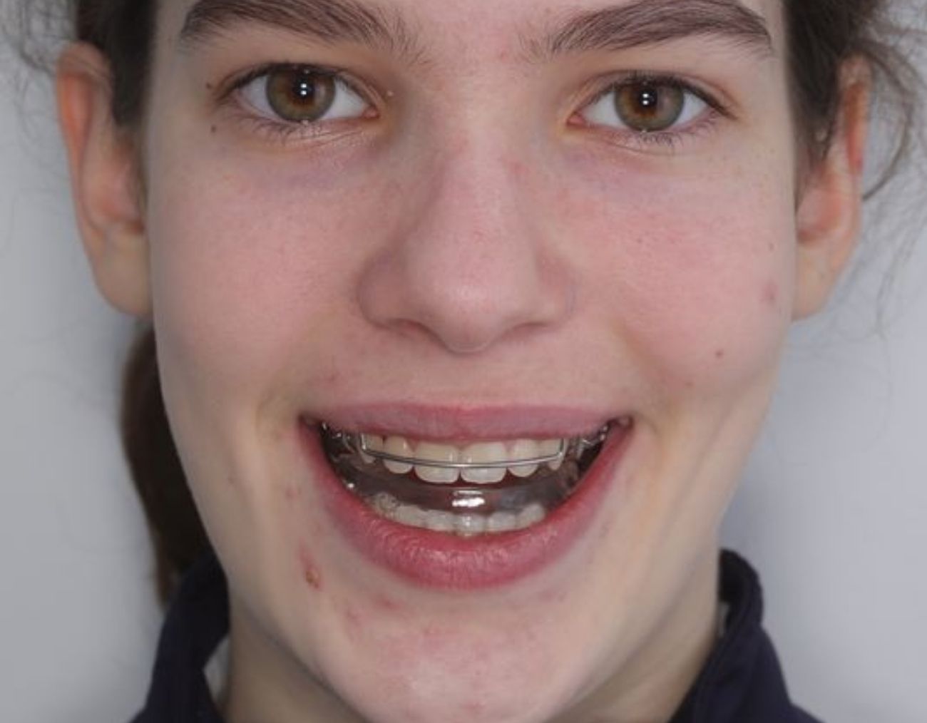 braces-after.jpg