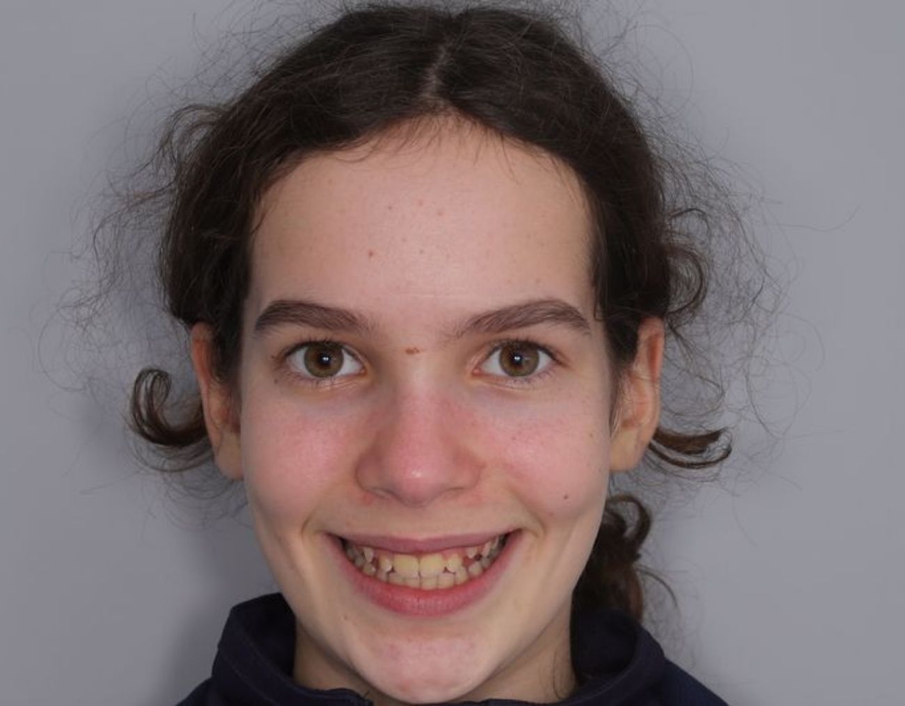braces-before.jpg