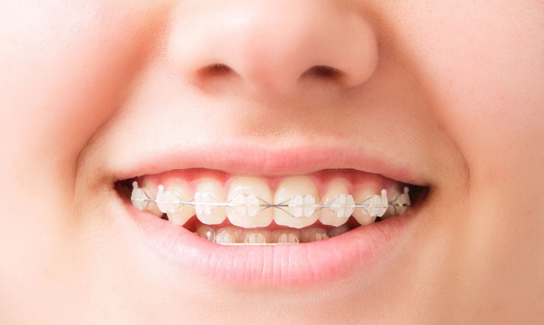 children fixed braces